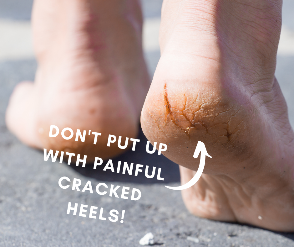 Cracked Heels - The Hartland Podiatry Clinic